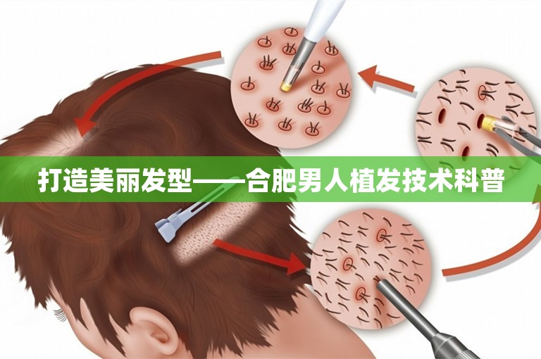 打造美丽发型——合肥男人植发技术科普