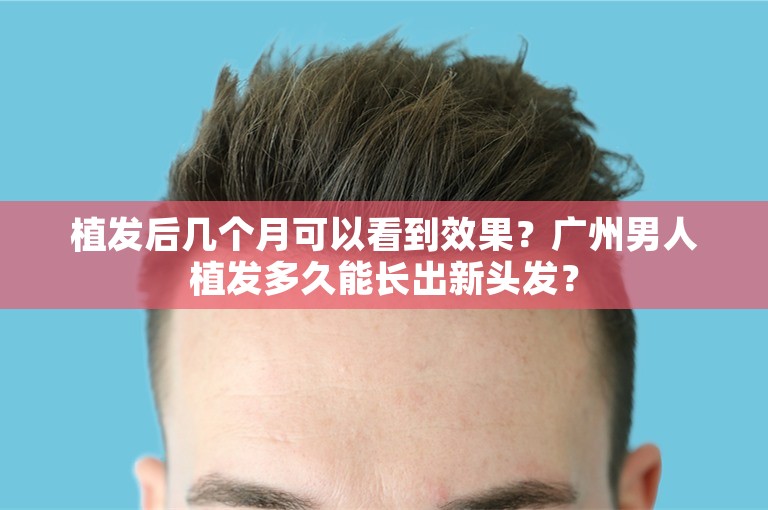 植发后几个月可以看到效果？广州男人植发多久能长出新头发？