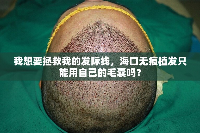 我想要拯救我的发际线，海口无痕植发只能用自己的毛囊吗？