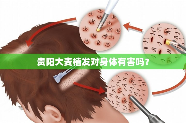 贵阳大麦植发对身体有害吗？