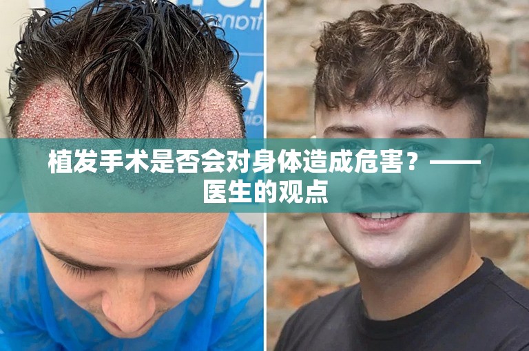 植发手术是否会对身体造成危害？——医生的观点