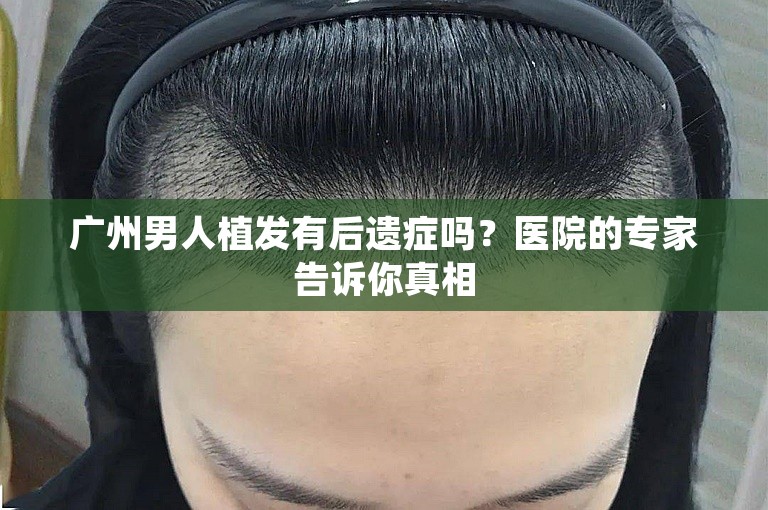 广州男人植发有后遗症吗？医院的专家告诉你真相