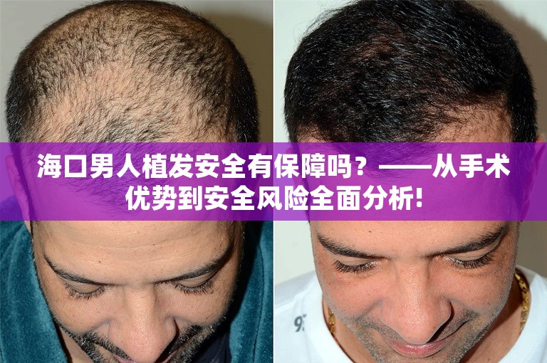 海口男人植发安全有保障吗？——从手术优势到安全风险全面分析!