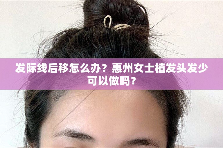 发际线后移怎么办？惠州女士植发头发少可以做吗？