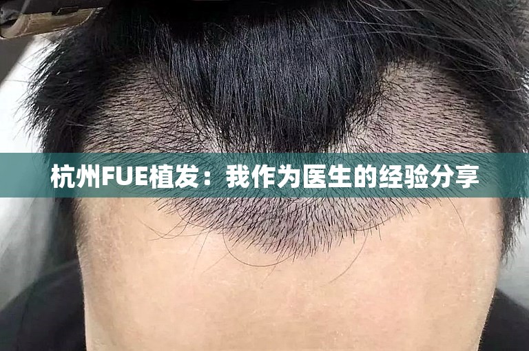 杭州FUE植发：我作为医生的经验分享