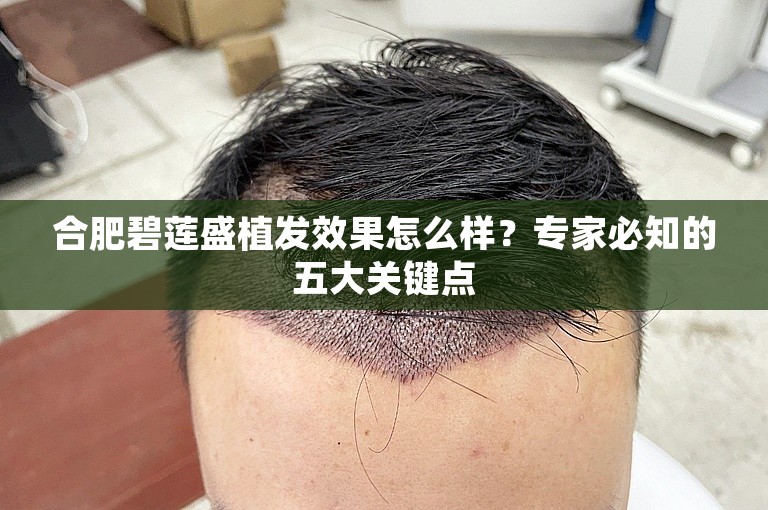 合肥碧莲盛植发效果怎么样？专家必知的五大关键点