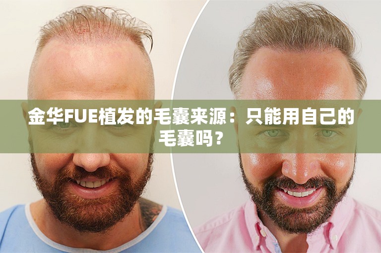 金华FUE植发的毛囊来源：只能用自己的毛囊吗？