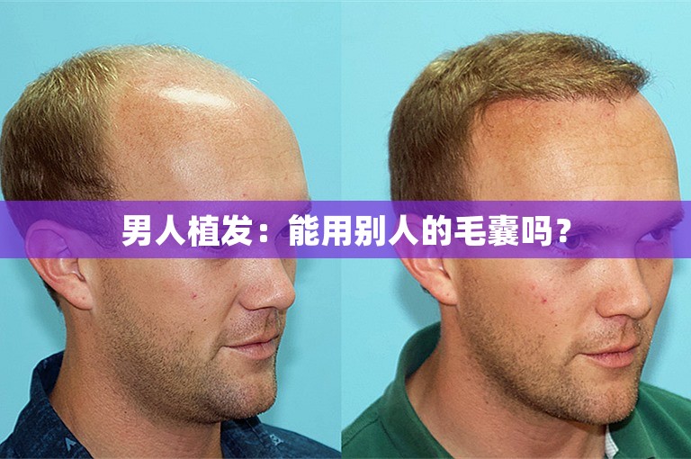 男人植发：能用别人的毛囊吗？