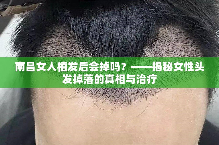 南昌女人植发后会掉吗？——揭秘女性头发掉落的真相与治疗