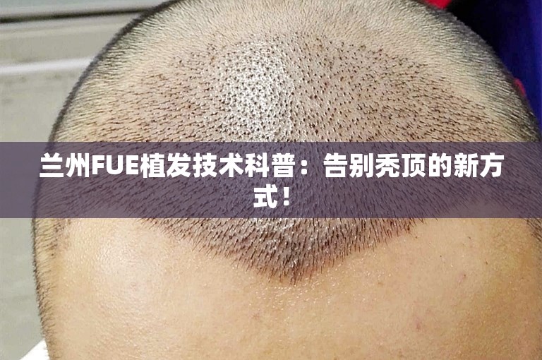 兰州FUE植发技术科普：告别秃顶的新方式！