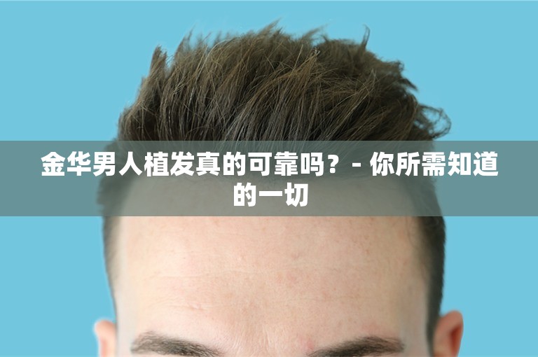 金华男人植发真的可靠吗？- 你所需知道的一切