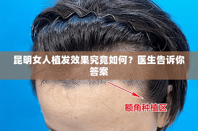 昆明女人植发效果究竟如何？医生告诉你答案