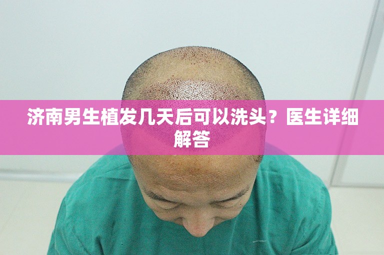 济南男生植发几天后可以洗头？医生详细解答