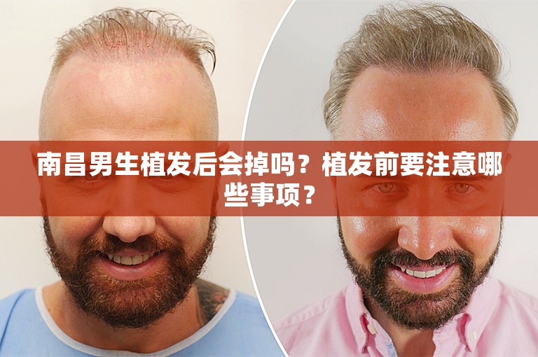 南昌男生植发后会掉吗？植发前要注意哪些事项？