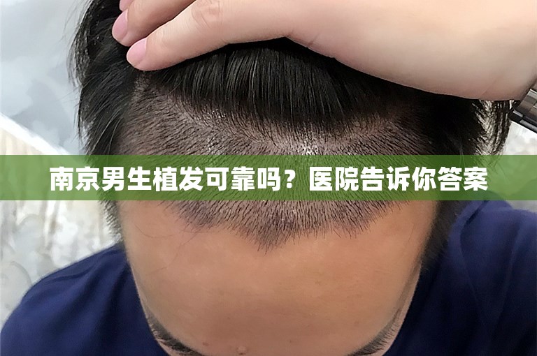 南京男生植发可靠吗？医院告诉你答案