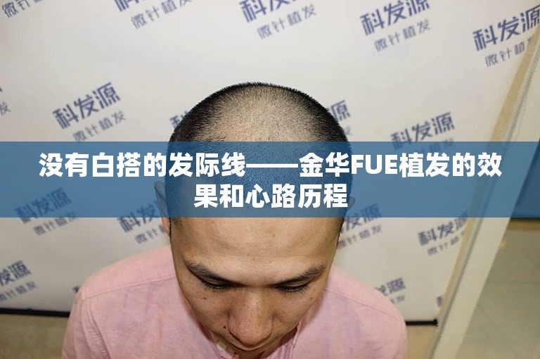 没有白搭的发际线——金华FUE植发的效果和心路历程