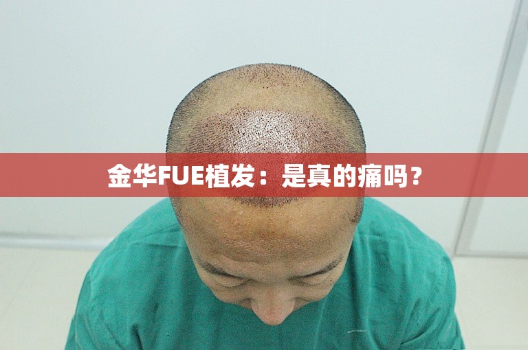 金华FUE植发：是真的痛吗？