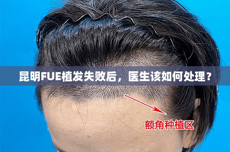 昆明FUE植发失败后，医生该如何处理？