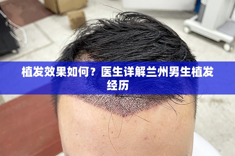 植发效果如何？医生详解兰州男生植发经历