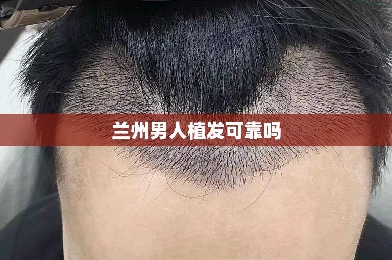 兰州男人植发可靠吗