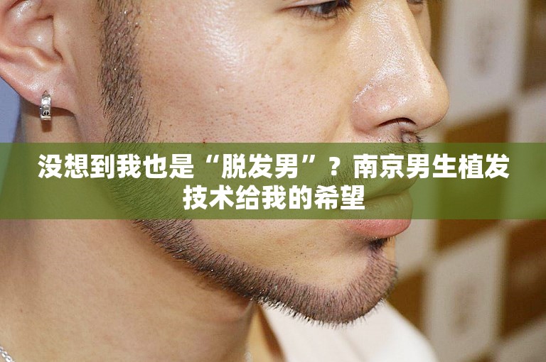 没想到我也是“脱发男”？南京男生植发技术给我的希望