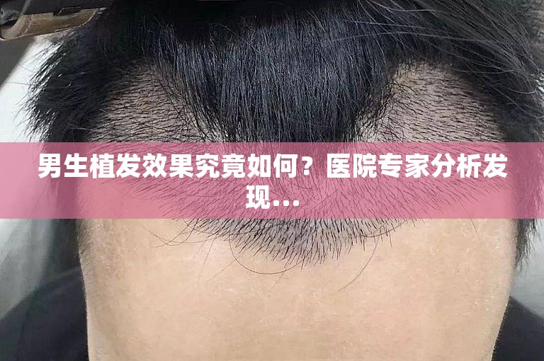 男生植发效果究竟如何？医院专家分析发现...