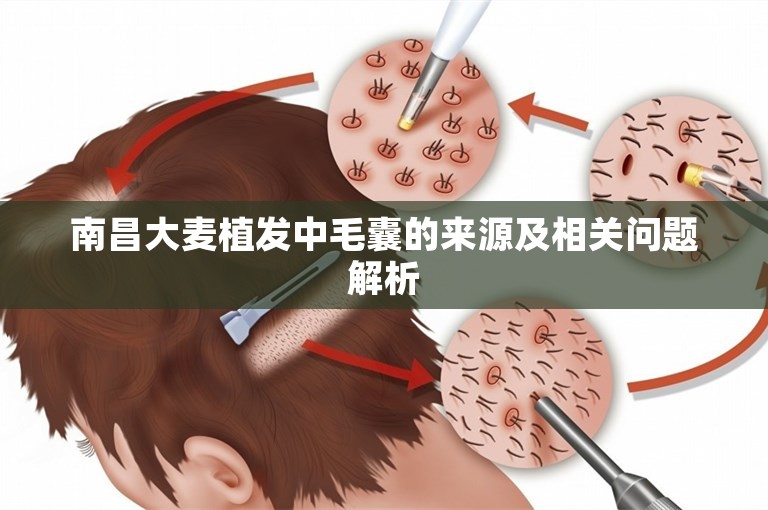 南昌大麦植发中毛囊的来源及相关问题解析