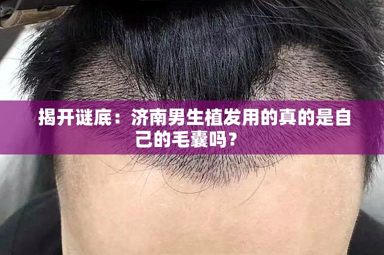  揭开谜底：济南男生植发用的真的是自己的毛囊吗？ 