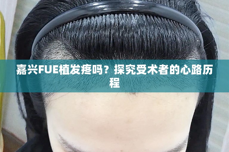 嘉兴FUE植发疼吗？探究受术者的心路历程