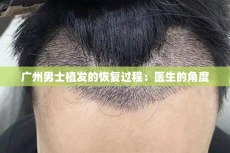 广州男士植发的恢复过程：医生的角度