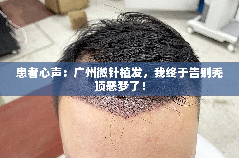 患者心声：广州微针植发，我终于告别秃顶恶梦了！