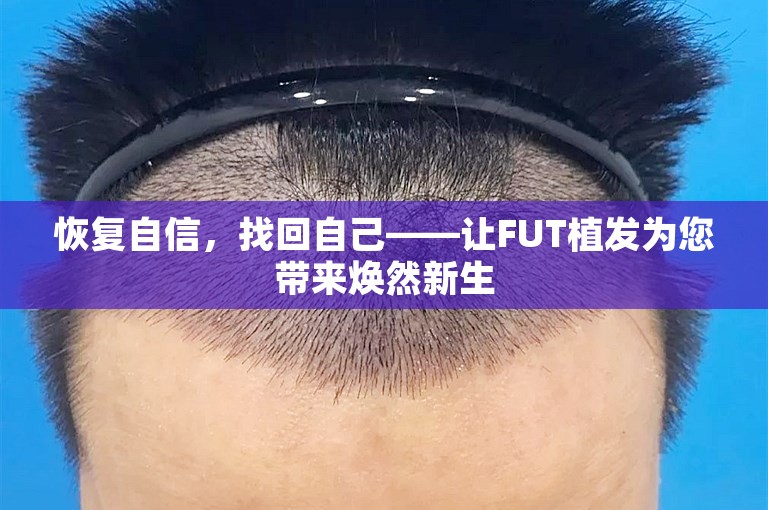 恢复自信，找回自己——让FUT植发为您带来焕然新生