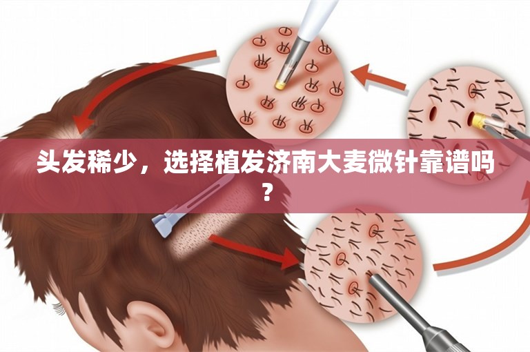 头发稀少，选择植发济南大麦微针靠谱吗？