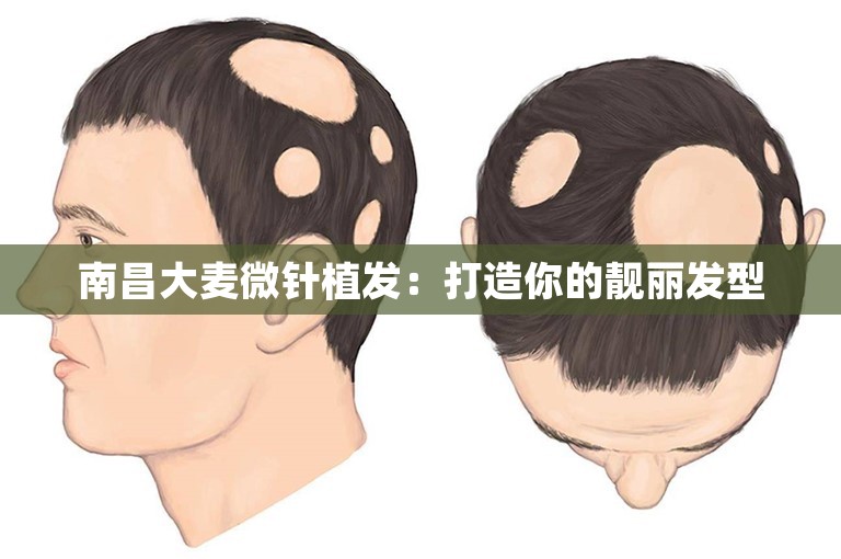 南昌大麦微针植发：打造你的靓丽发型