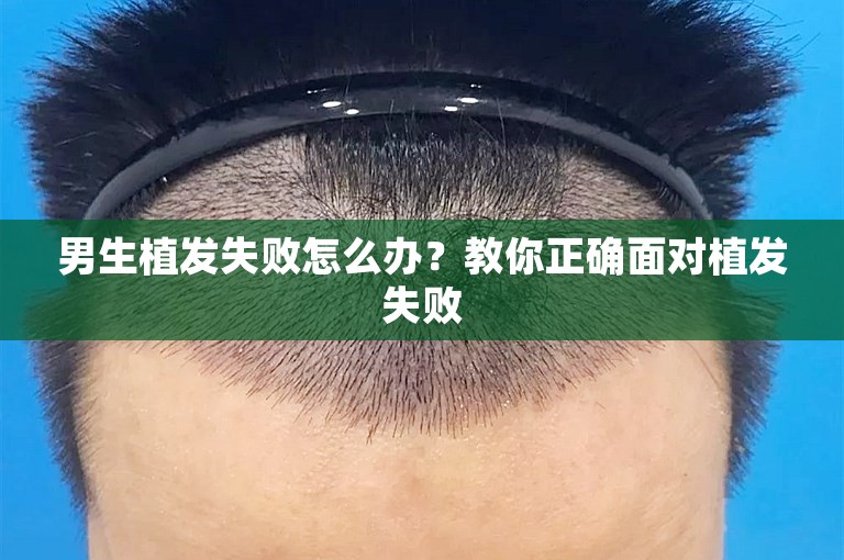 男生植发失败怎么办？教你正确面对植发失败