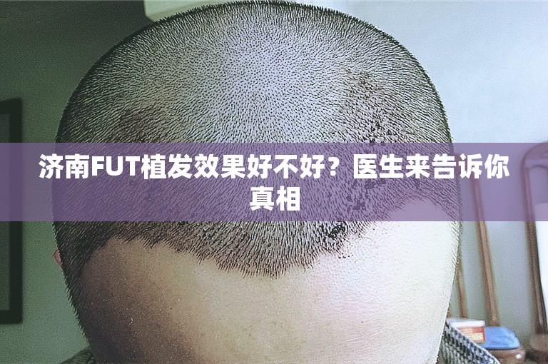 济南FUT植发效果好不好？医生来告诉你真相