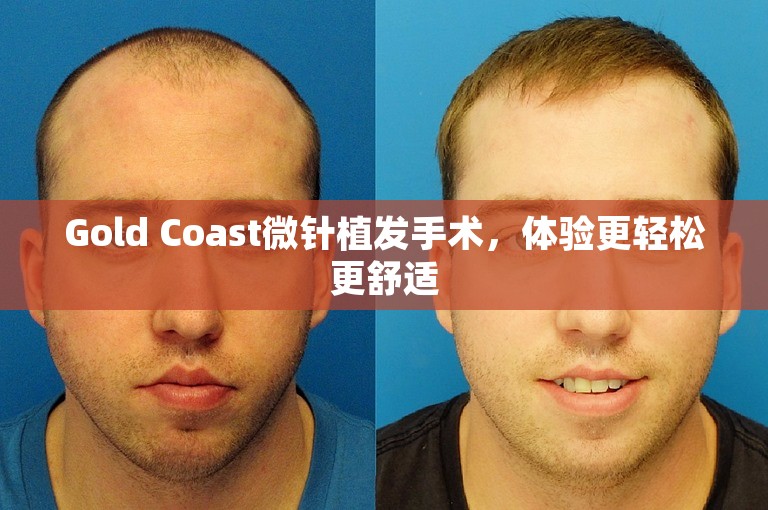 Gold Coast微针植发手术，体验更轻松更舒适