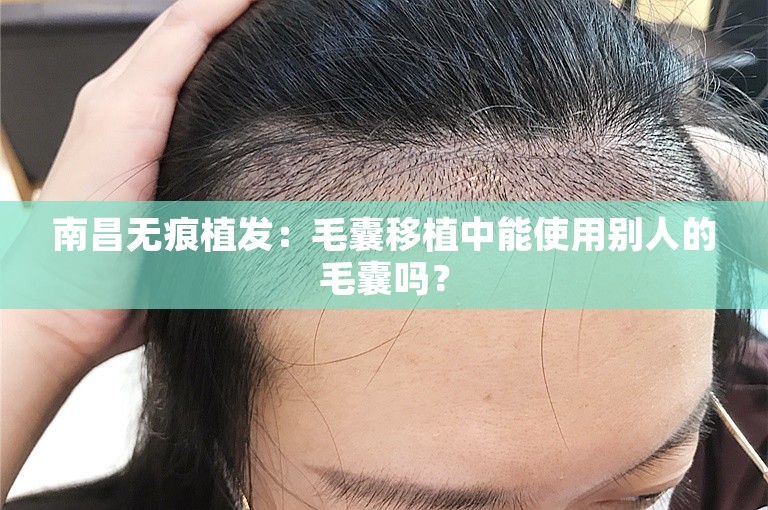 南昌无痕植发：毛囊移植中能使用别人的毛囊吗？