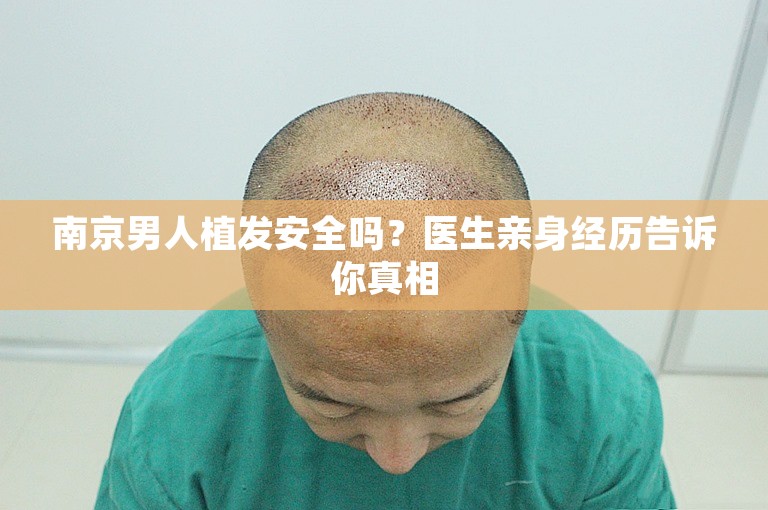 南京男人植发安全吗？医生亲身经历告诉你真相