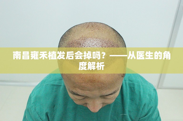 南昌雍禾植发后会掉吗？——从医生的角度解析