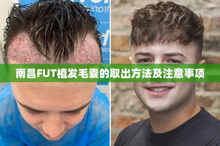 南昌FUT植发毛囊的取出方法及注意事项