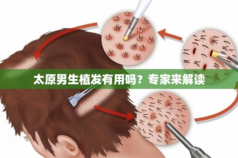 太原男生植发有用吗？专家来解读