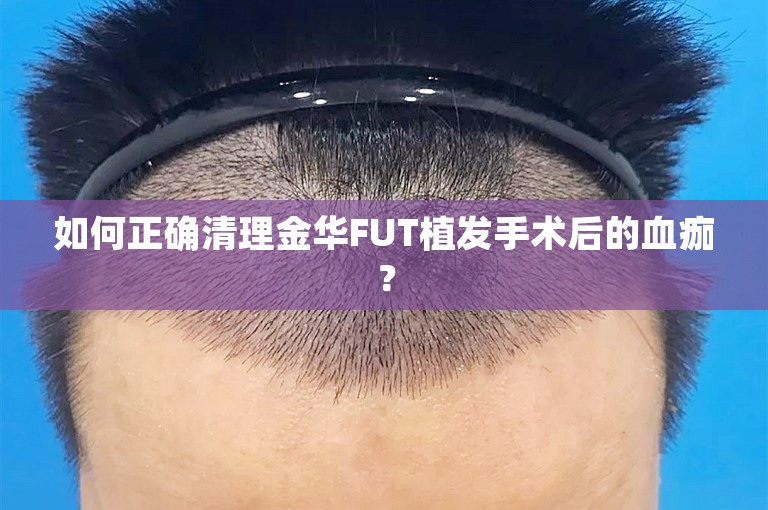 如何正确清理金华FUT植发手术后的血痂？