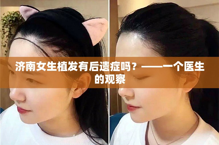 济南女生植发有后遗症吗？——一个医生的观察