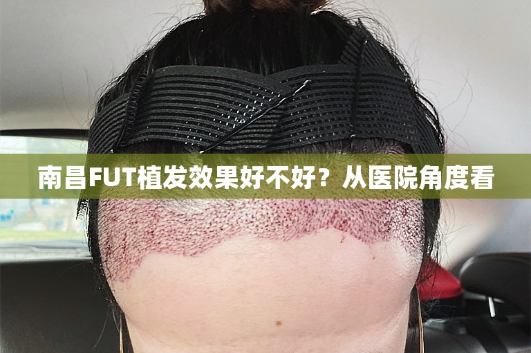 南昌FUT植发效果好不好？从医院角度看