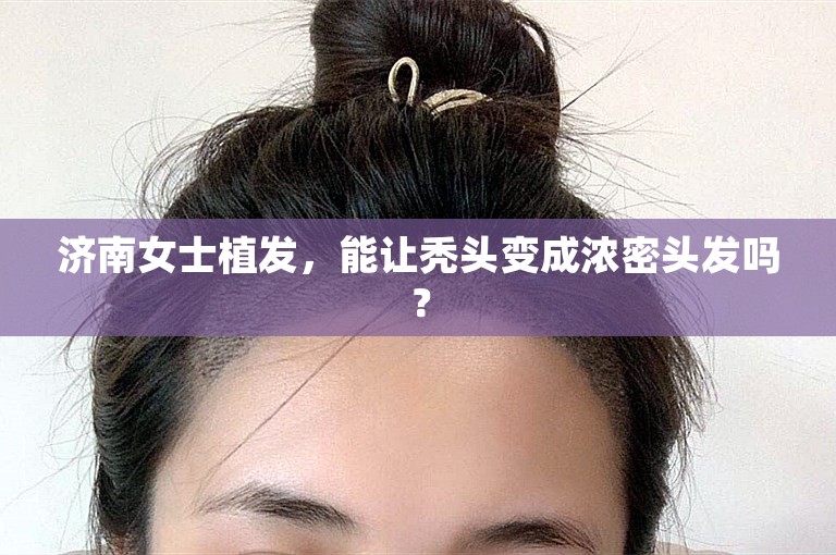 济南女士植发，能让秃头变成浓密头发吗？