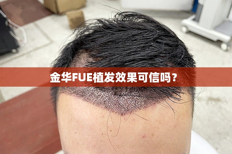  金华FUE植发效果可信吗？ 