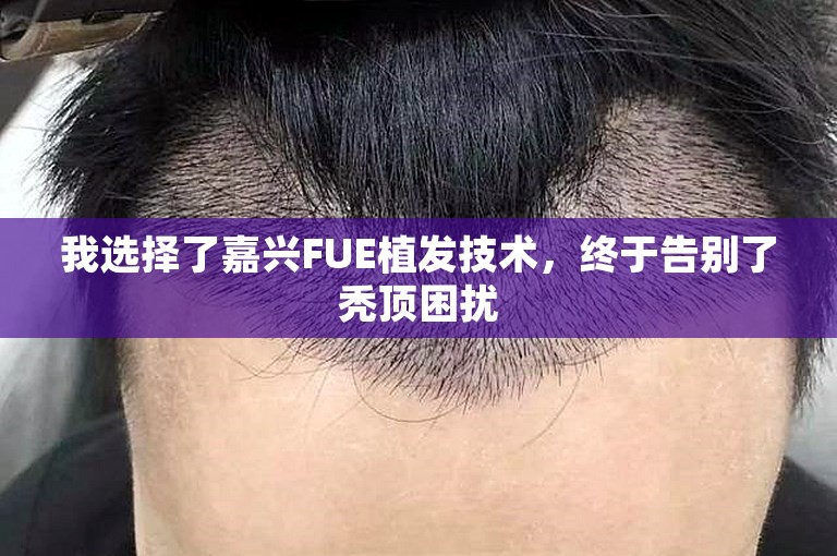 我选择了嘉兴FUE植发技术，终于告别了秃顶困扰