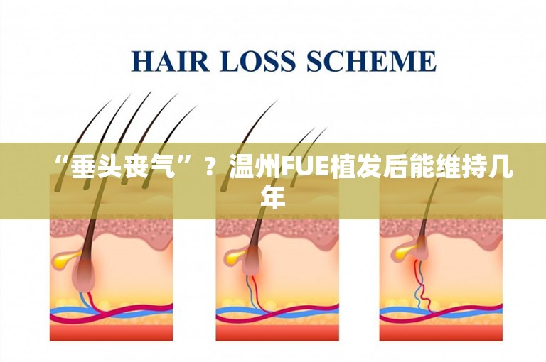 “垂头丧气”？温州FUE植发后能维持几年