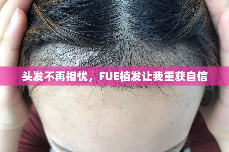 头发不再担忧，FUE植发让我重获自信